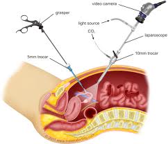 infertility Laparoscopic Surgery