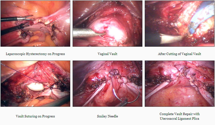 Laparoscopic Hysterectomy on Progress