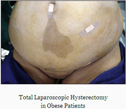 Total Laparoscopic Hysterectomy in Obese Patients