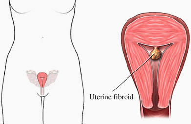 Uterine Fibroid