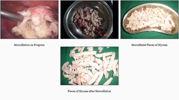 OUTCOMES FROM MYOMECTOMY