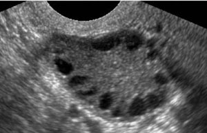 PCO Ultrasound view