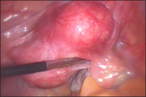 Laparoscopic Picture of Fibroid Uterus