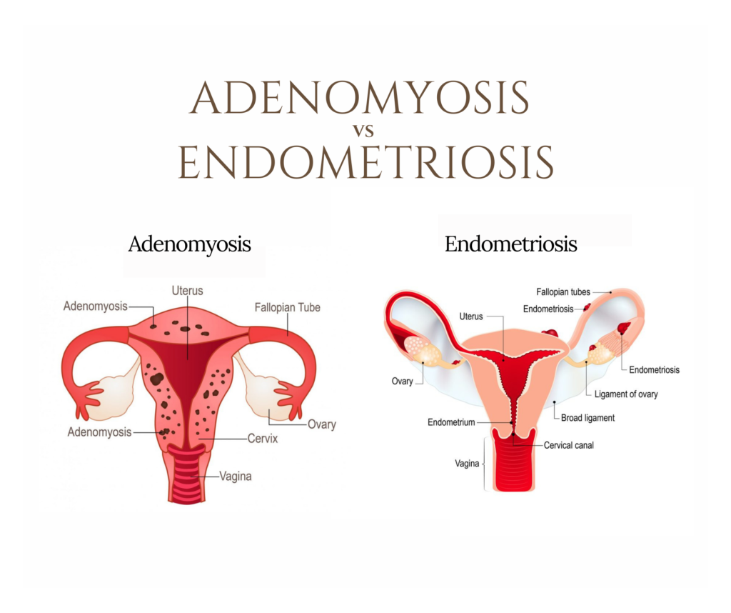 difference-between-endometriosis-and-adenomyosis-gynaecologist-kolkata