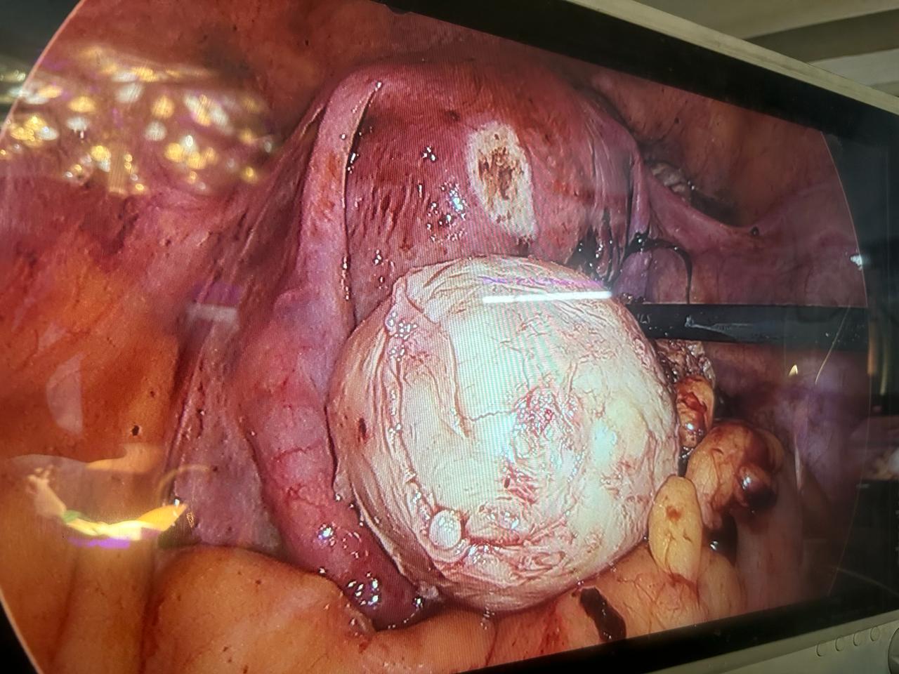 Fibroid Surgery in Kolkata, India