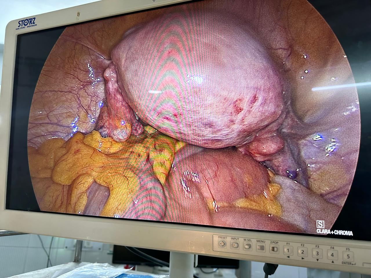 laparoscopic hysterectomy surgery