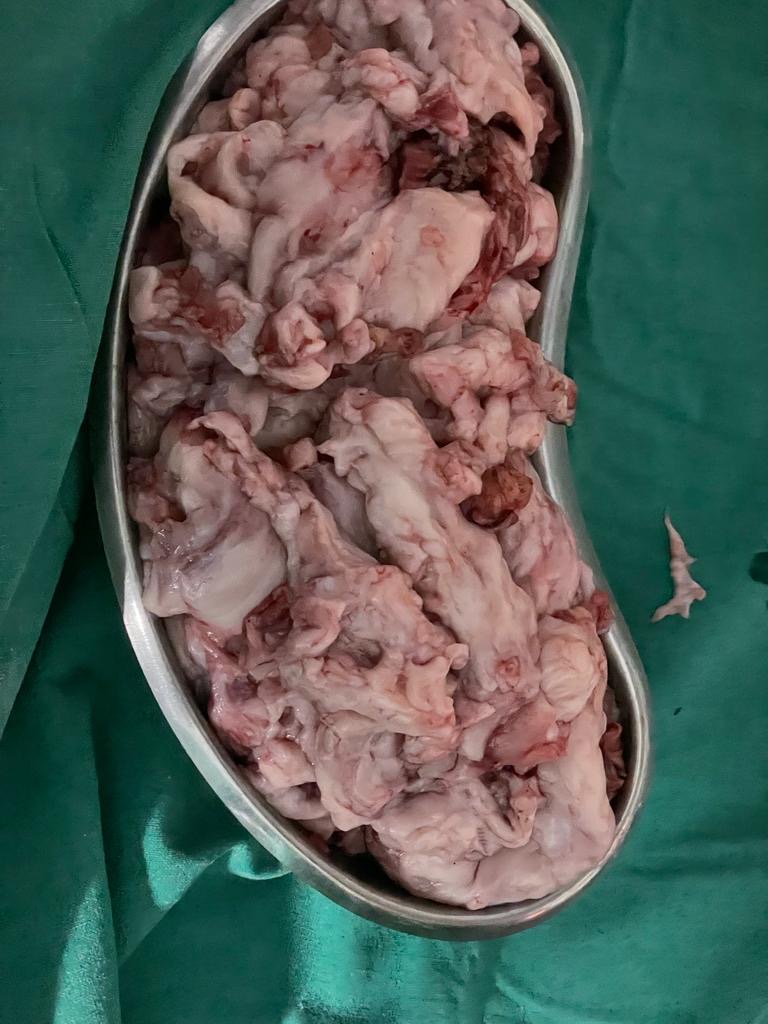 , laparoscopic myomectomy in Kolkata