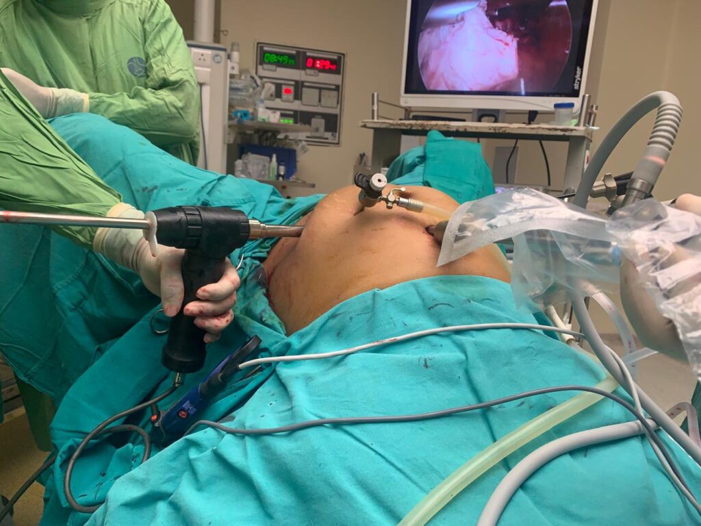 uterine fibroid removal surgery in India