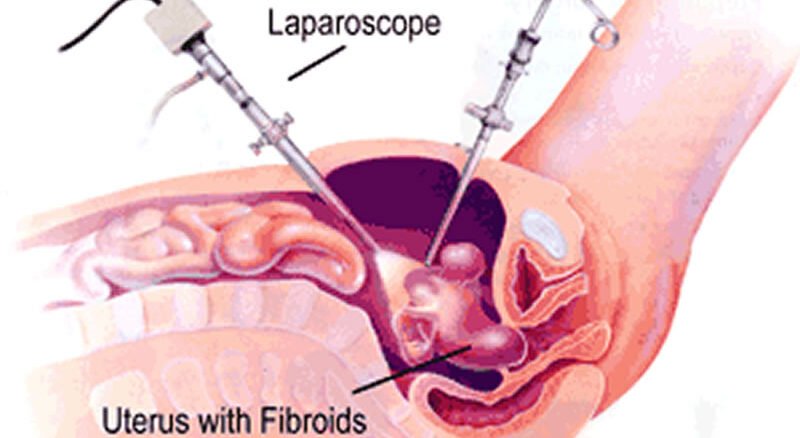 Laparoscopic Myomectomy Surgeon in Kolkata