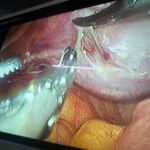 Laparoscopic repair of vault prolapse