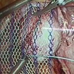 Laparoscopic repair of vault prolapse