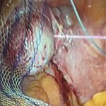 Laparoscopic repair of vault prolapse