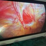Laparoscopic repair of vault prolapse