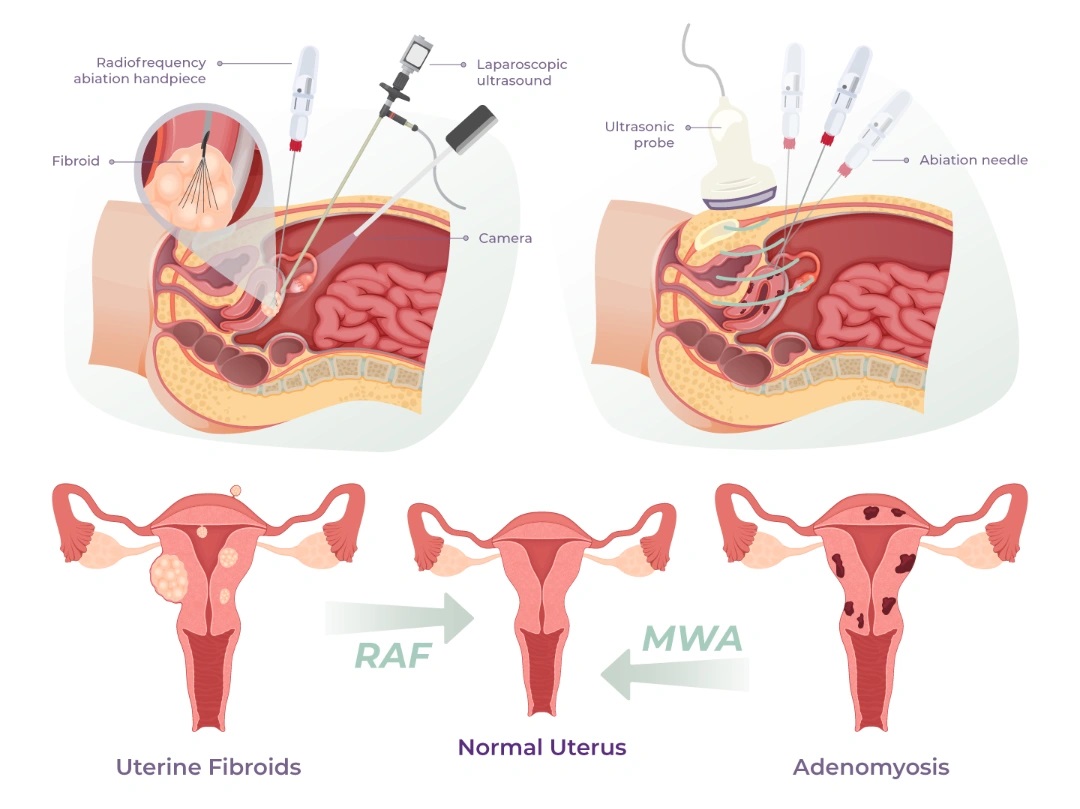 Microwave Ablation Therapy for Adenomyosis