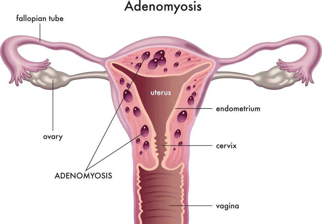Microwave Ablation Therapy for Adenomyosis