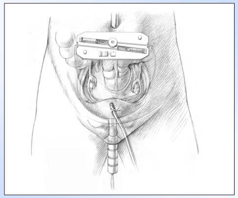 Laparoscopic Creation of Neovagina