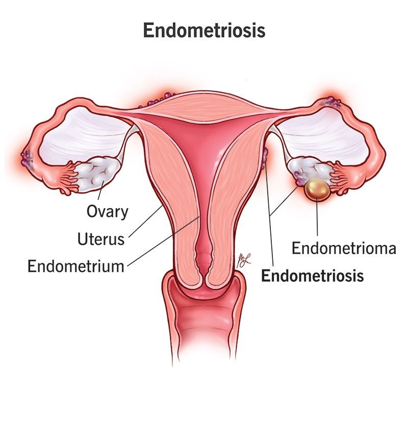 Best Endometriosis Surgeon in Kolkata