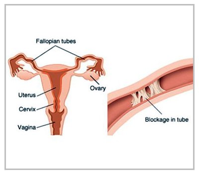 Blocked Fallopian Tubes