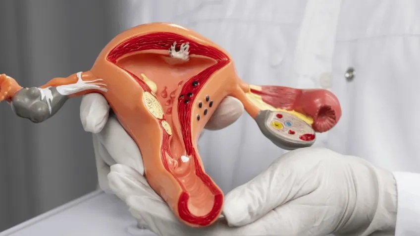 Endometriosis & Infertility